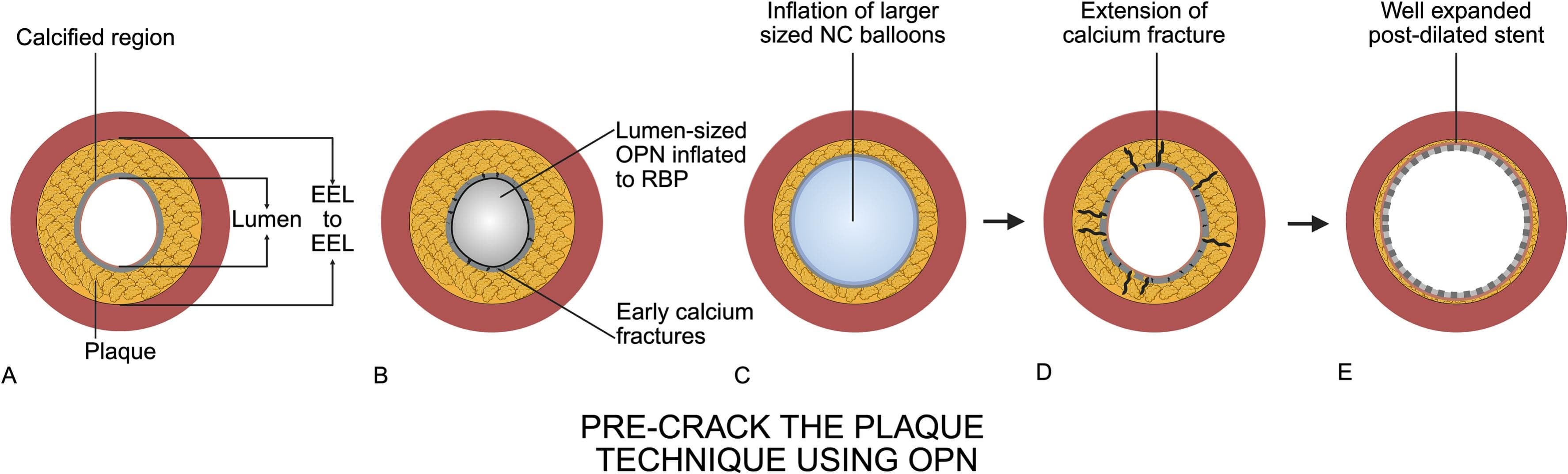 La technique « Pre-Crack the Plaque » avec le ballon OPN de SIS Medical